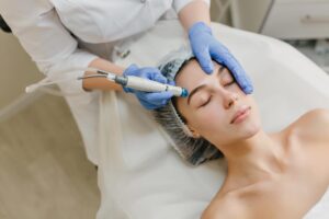 Microneedling